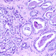 A histological slide showing prostate cancer. (Image: National Cancer Institute/Otis Brawley)